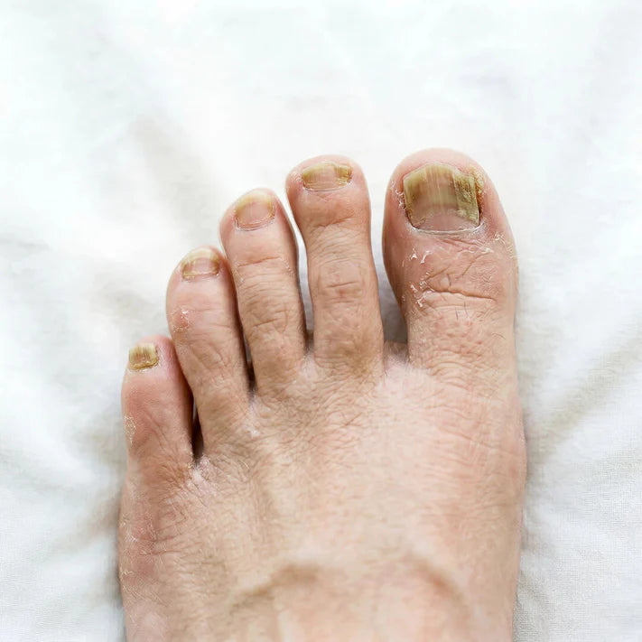 The Hidden Struggle: My 5-Year Nail Nightmare